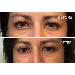 Endure Beauty - Under Eye Therapy Pads Rejuvenating Formula - 5-pack