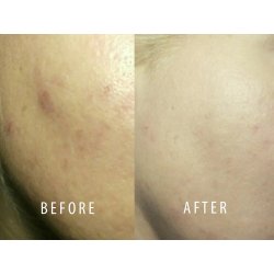 TURBLISS - Bioactive Peat mask - problem skin 150ml